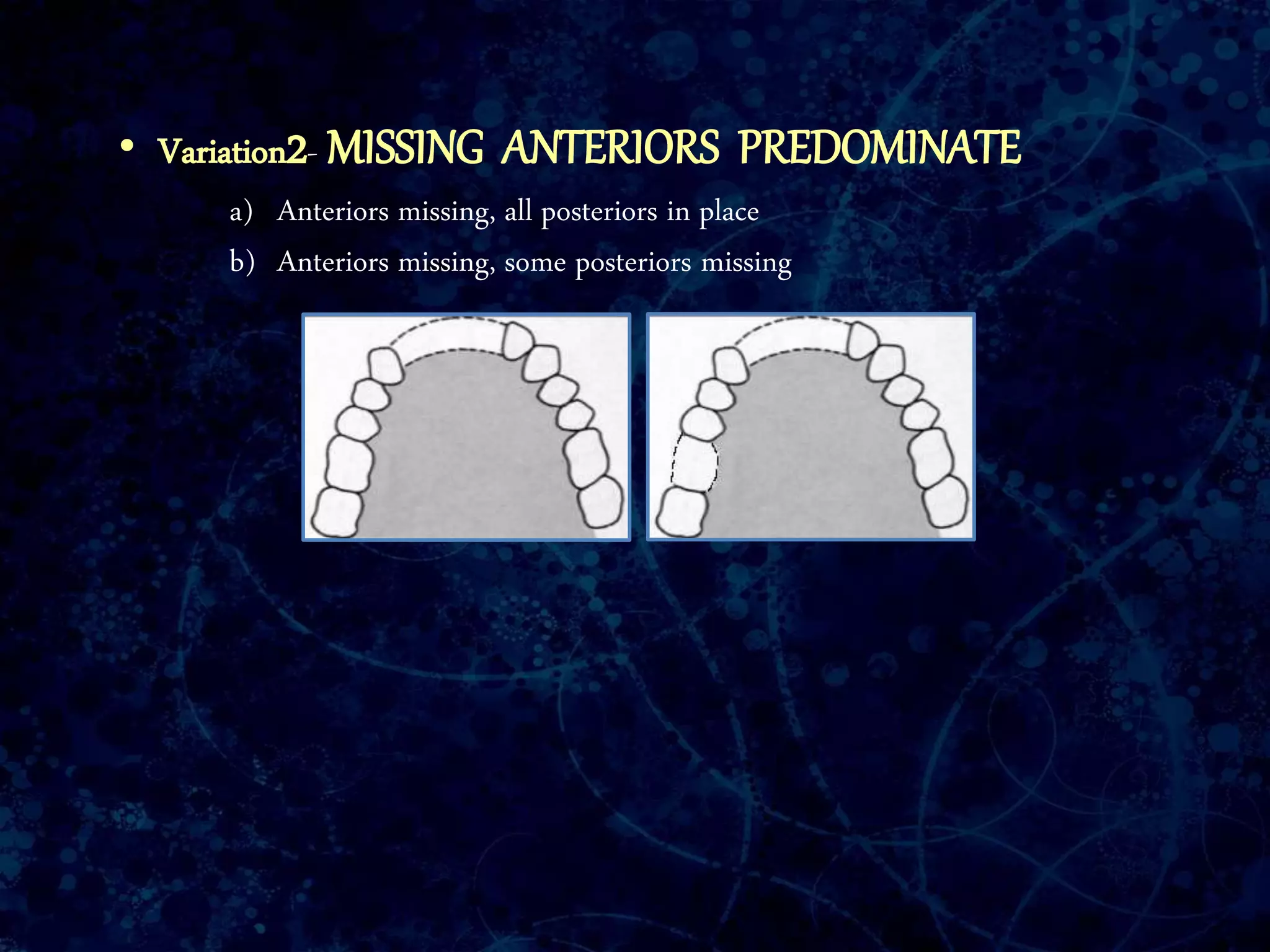 • Variation2- MISSING ANTERIORS PREDOMINATE
a) Anteriors missing, all posteriors in place
b) Anteriors missing, some posteriors missing
 