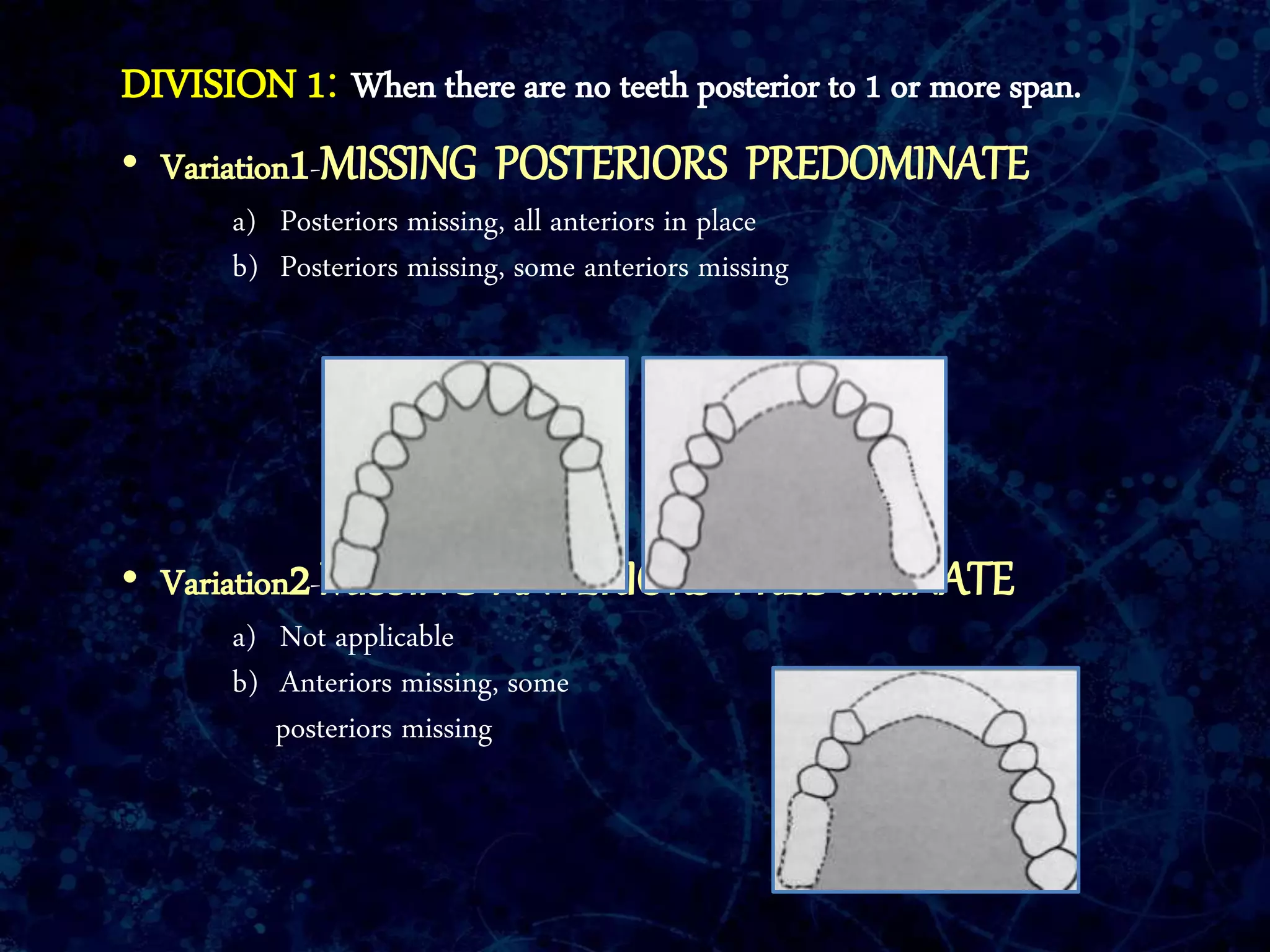 DIVISION 1: When there are no teeth posterior to 1 or more span.
• Variation1-MISSING POSTERIORS PREDOMINATE
a) Posteriors missing, all anteriors in place
b) Posteriors missing, some anteriors missing
• Variation2-MISSING ANTERIORS PREDOMINATE
a) Not applicable
b) Anteriors missing, some
posteriors missing
 