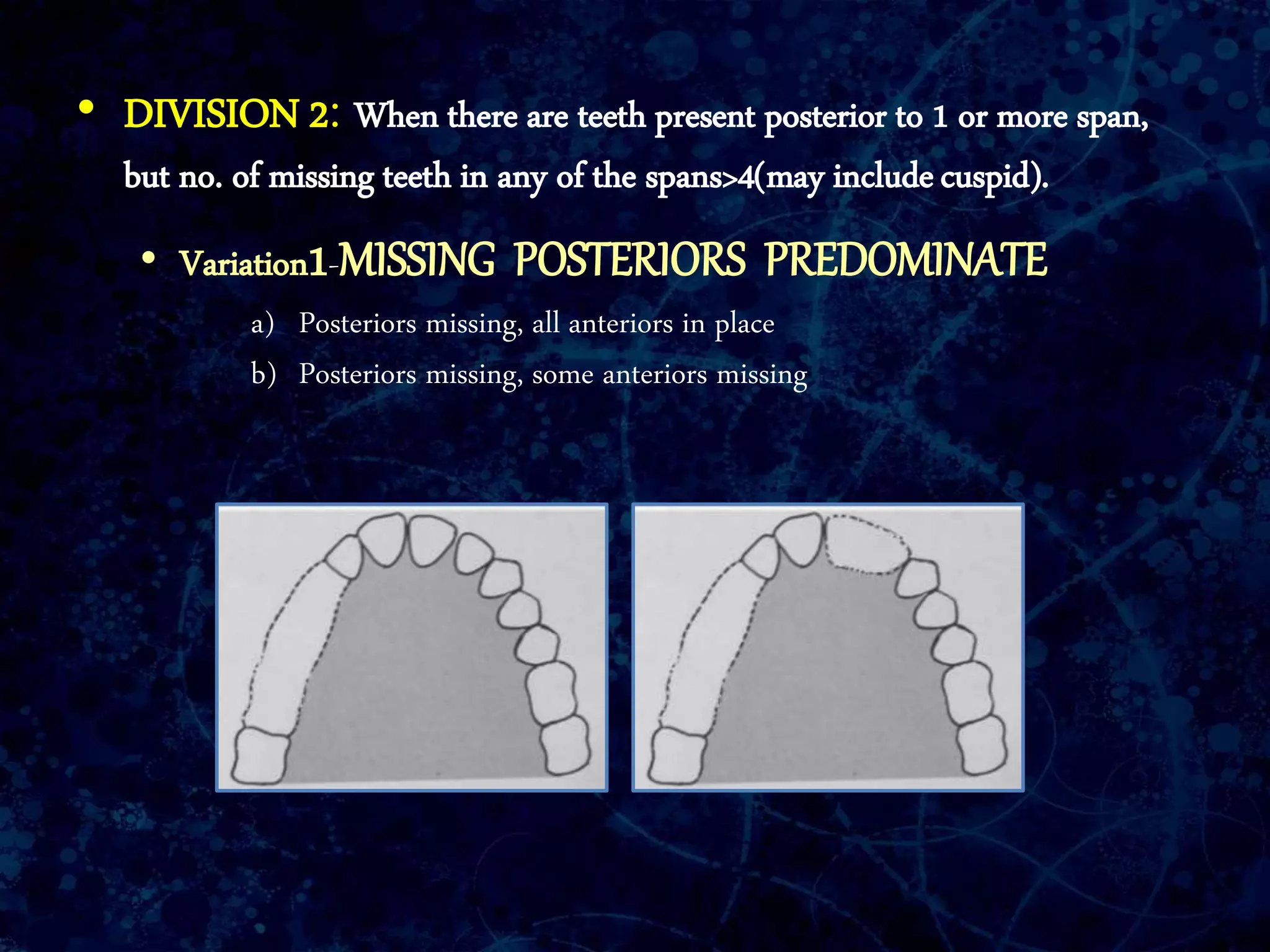 • DIVISION 2: When there are teeth present posterior to 1 or more span,
but no. of missing teeth in any of the spans>4(may includecuspid).
• Variation1-MISSING POSTERIORS PREDOMINATE
a) Posteriors missing, all anteriors in place
b) Posteriors missing, some anteriors missing
 