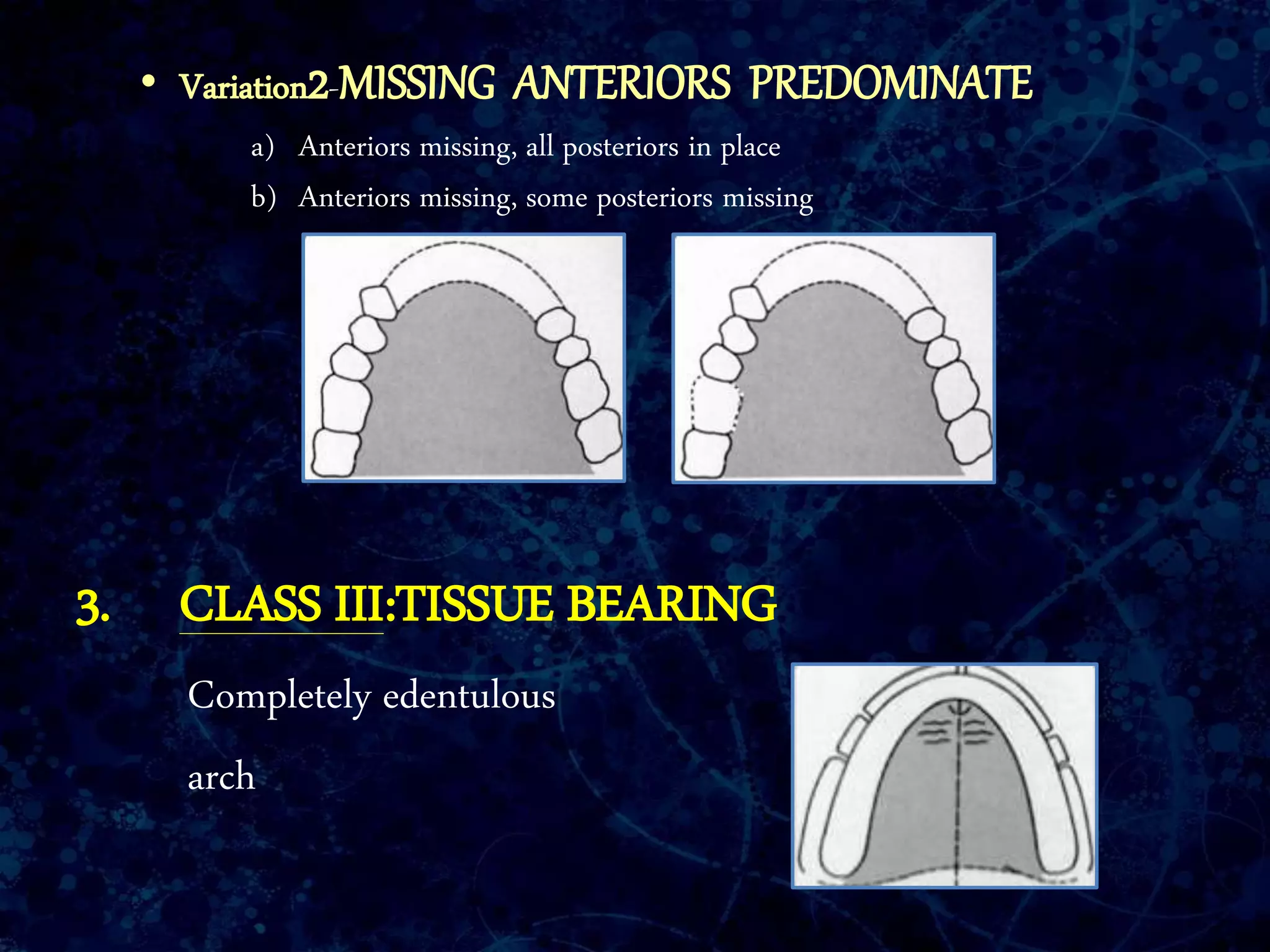 • Variation2-MISSING ANTERIORS PREDOMINATE
a) Anteriors missing, all posteriors in place
b) Anteriors missing, some posteriors missing
3. CLASS III:TISSUE BEARING
Completely edentulous
arch
 