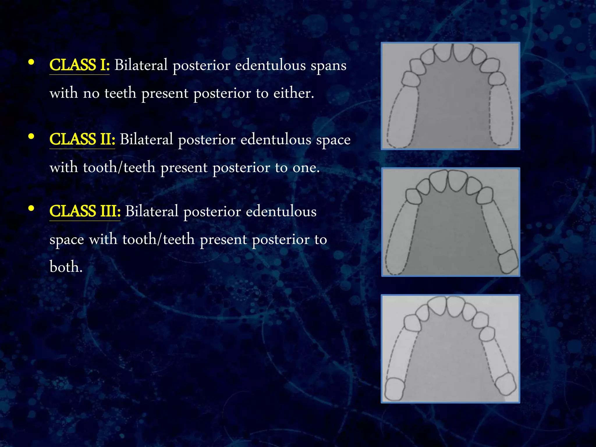 • CLASS I: Bilateral posterior edentulous spans
with no teeth present posterior to either.
• CLASS II: Bilateral posterior edentulous space
with tooth/teeth present posterior to one.
• CLASS III: Bilateral posterior edentulous
space with tooth/teeth present posterior to
both.
 