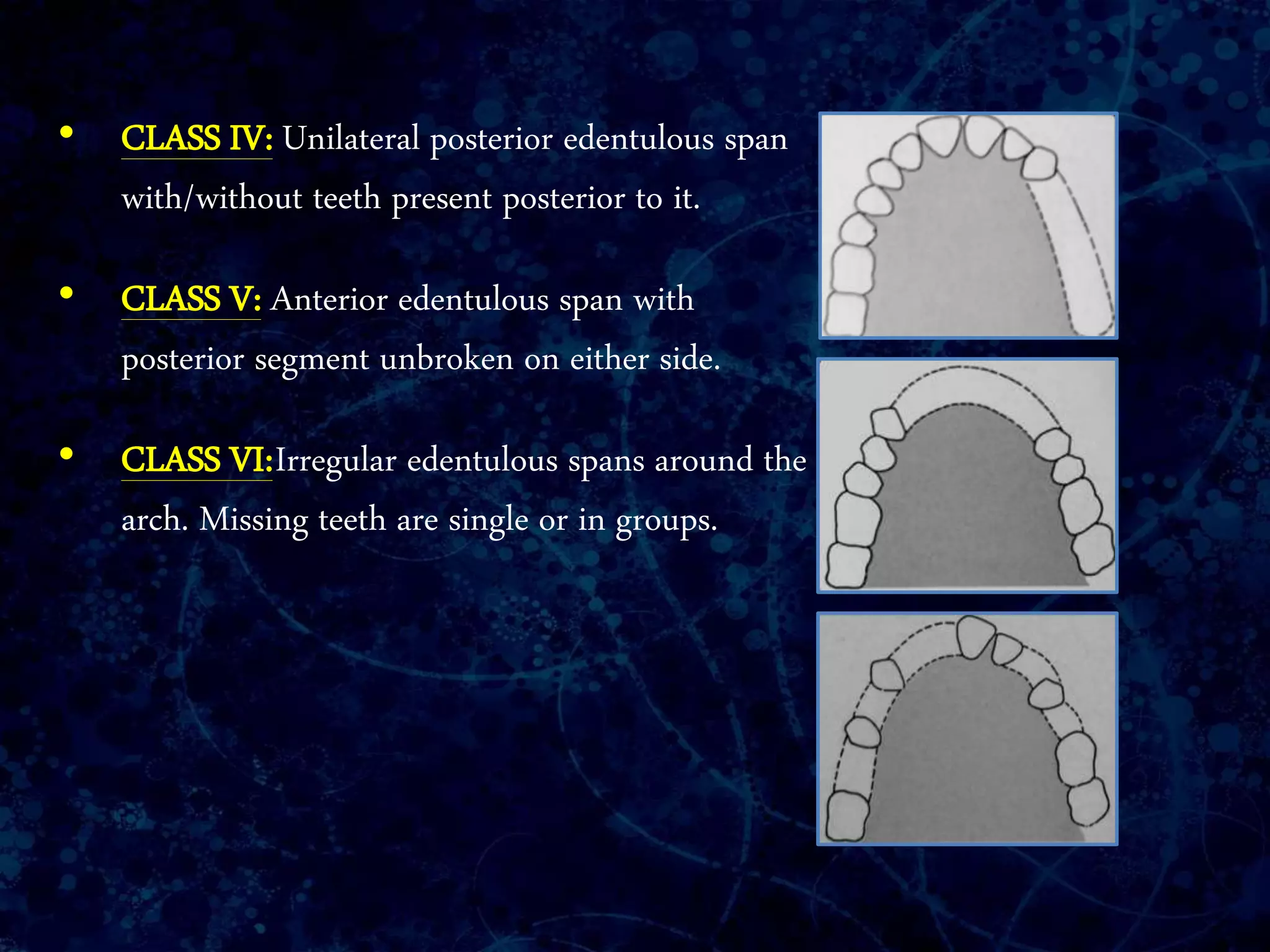 • CLASS IV: Unilateral posterior edentulous span
with/without teeth present posterior to it.
• CLASS V: Anterior edentulous span with
posterior segment unbroken on either side.
• CLASS VI:Irregular edentulous spans around the
arch. Missing teeth are single or in groups.
 