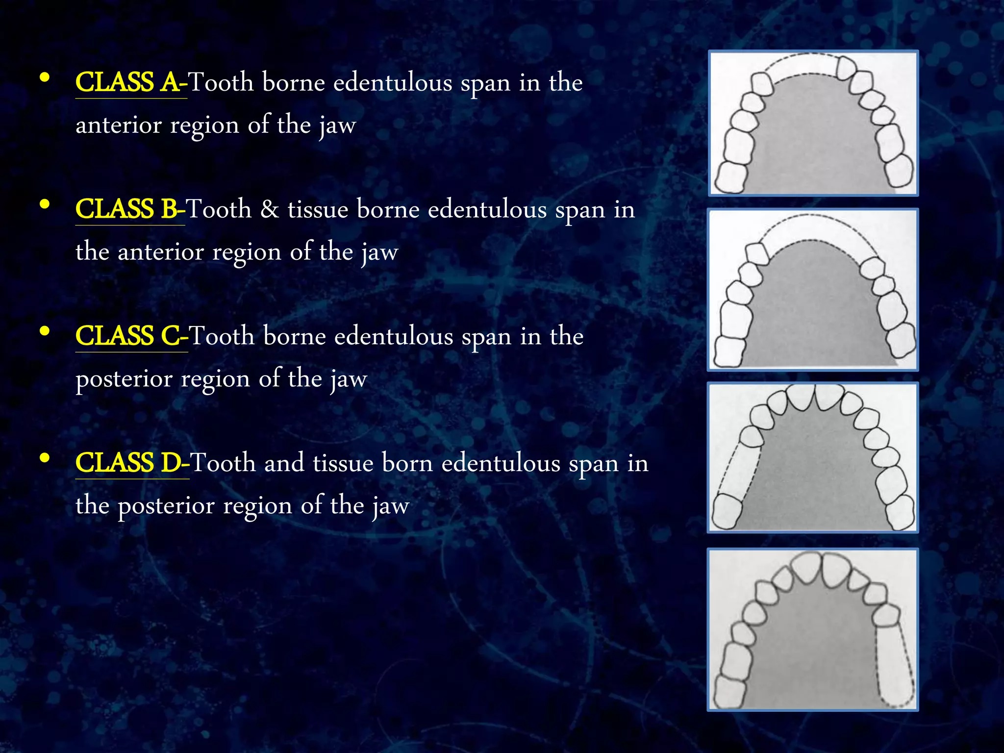 • CLASS A-Tooth borne edentulous span in the
anterior region of the jaw
• CLASS B-Tooth & tissue borne edentulous span in
the anterior region of the jaw
• CLASS C-Tooth borne edentulous span in the
posterior region of the jaw
• CLASS D-Tooth and tissue born edentulous span in
the posterior region of the jaw
 