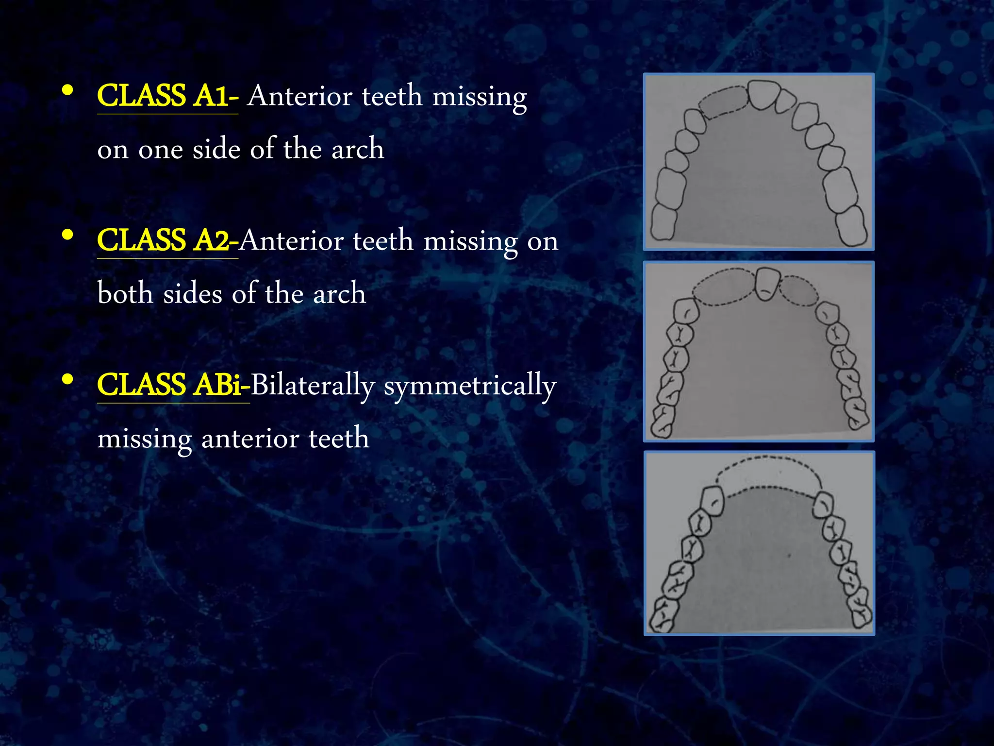 • CLASS A1- Anterior teeth missing
on one side of the arch
• CLASS A2-Anterior teeth missing on
both sides of the arch
• CLASS ABi-Bilaterally symmetrically
missing anterior teeth
 