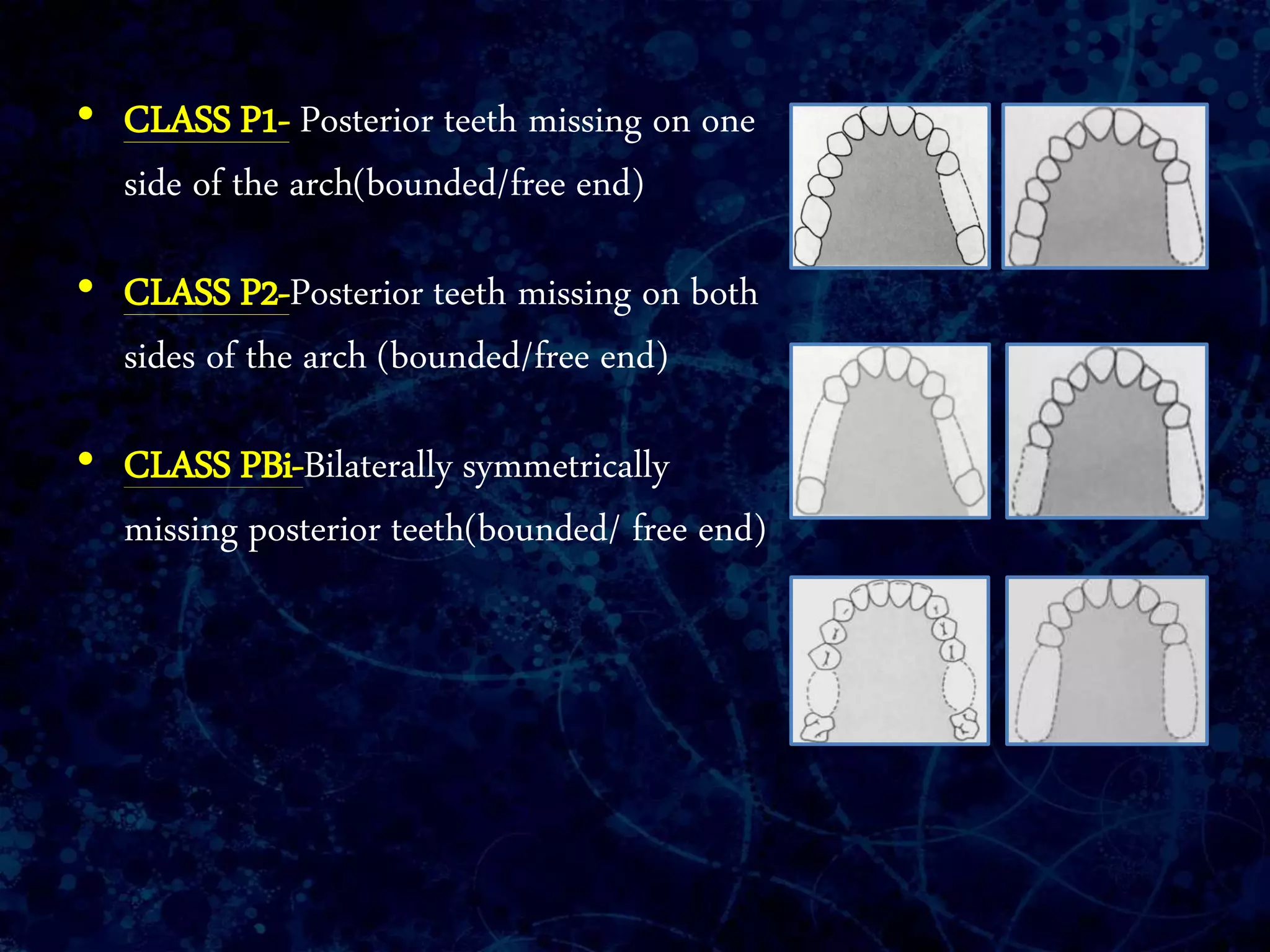 • CLASS P1- Posterior teeth missing on one
side of the arch(bounded/free end)
• CLASS P2-Posterior teeth missing on both
sides of the arch (bounded/free end)
• CLASS PBi-Bilaterally symmetrically
missing posterior teeth(bounded/ free end)
 