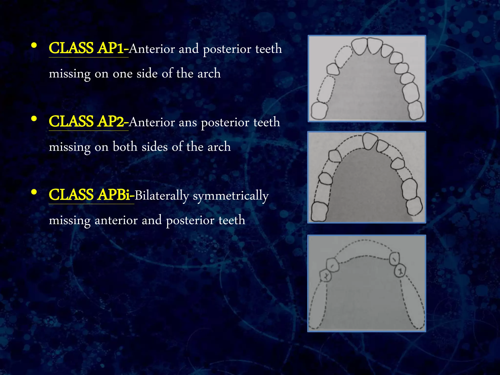 • CLASS AP1-Anterior and posterior teeth
missing on one side of the arch
• CLASS AP2-Anterior ans posterior teeth
missing on both sides of the arch
• CLASS APBi-Bilaterally symmetrically
missing anterior and posterior teeth
 
