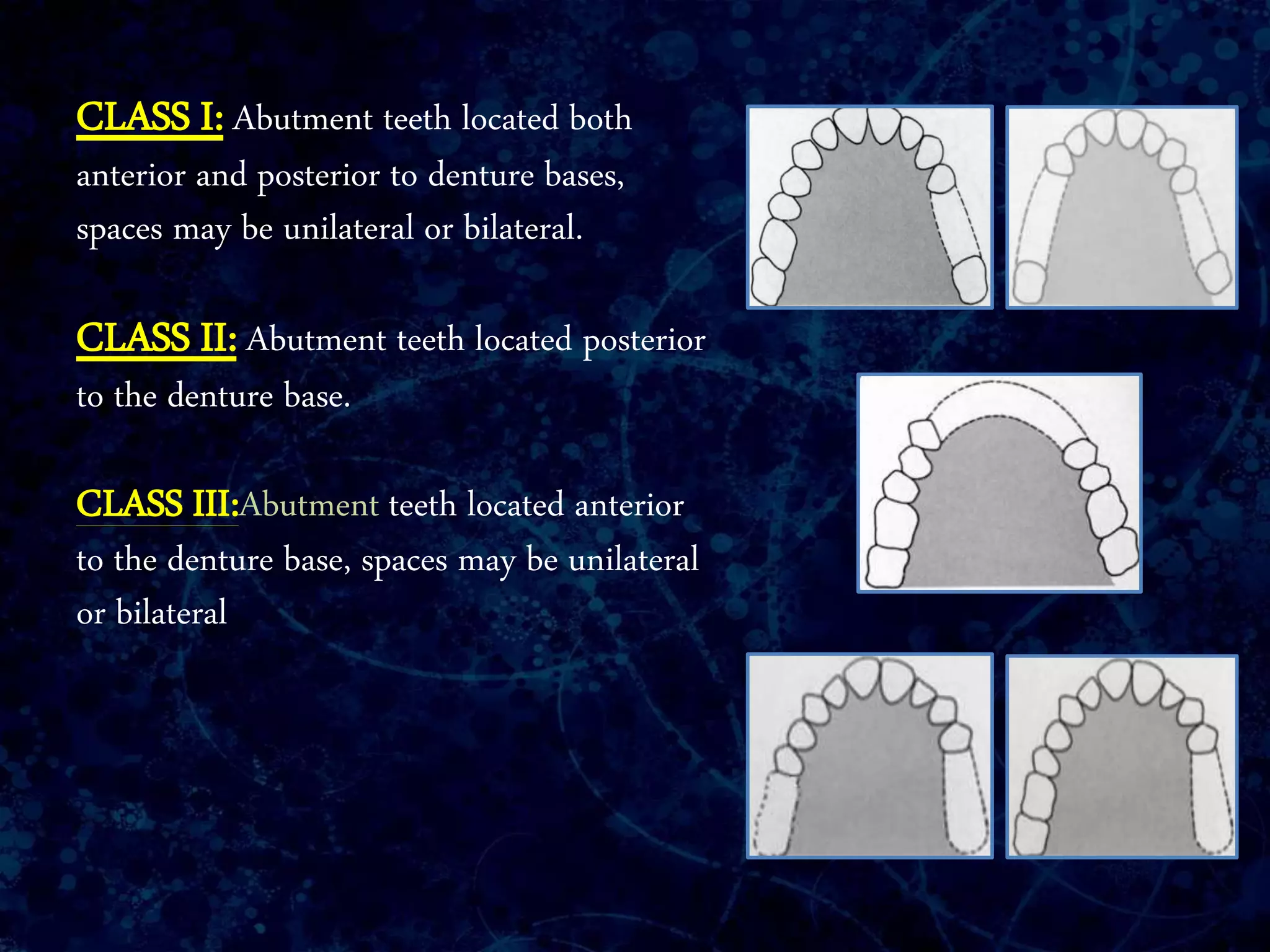 CLASS I: Abutment teeth located both
anterior and posterior to denture bases,
spaces may be unilateral or bilateral.
CLASS II: Abutment teeth located posterior
to the denture base.
CLASS III:Abutment teeth located anterior
to the denture base, spaces may be unilateral
or bilateral
 