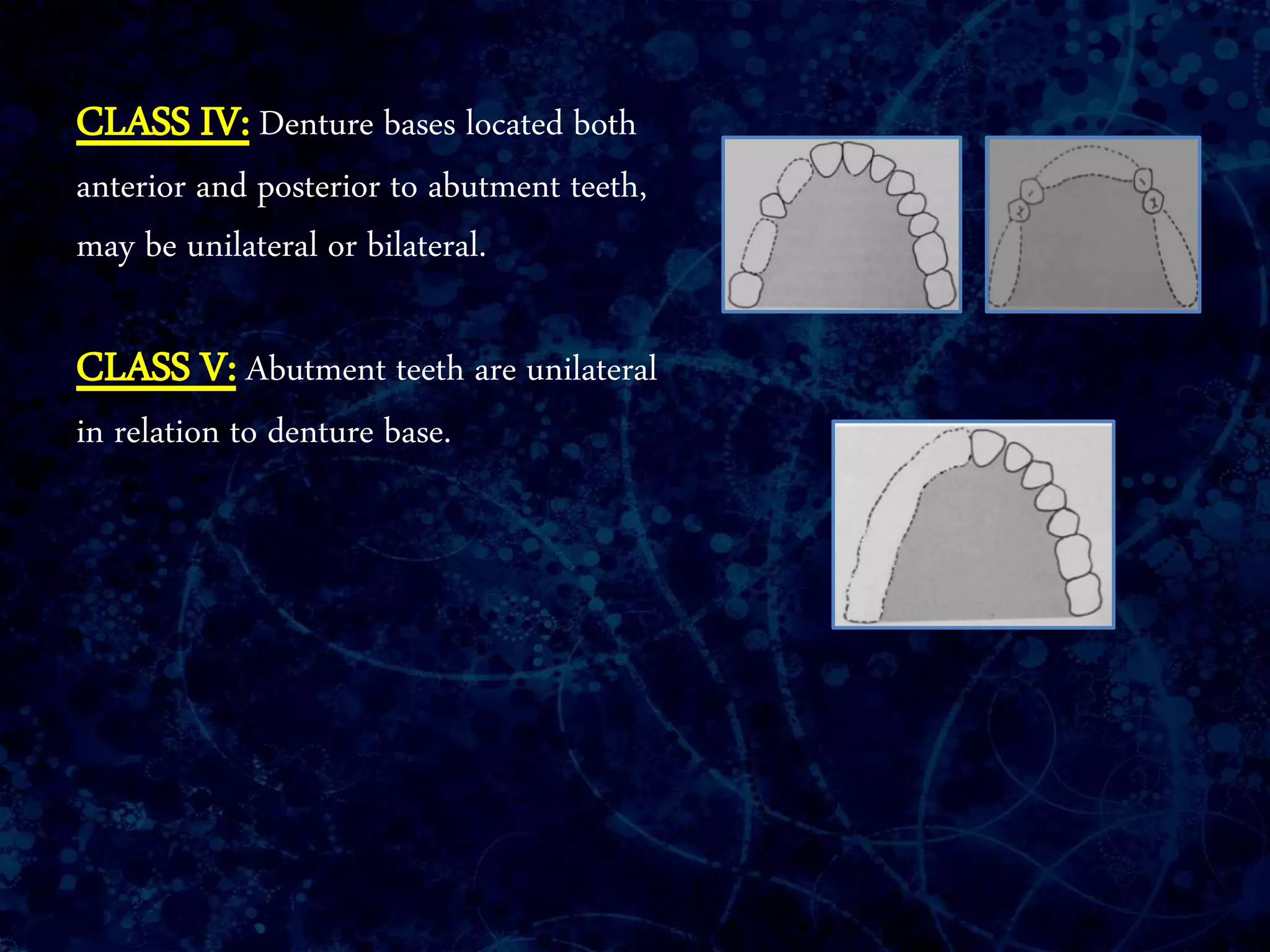 CLASS IV: Denture bases located both
anterior and posterior to abutment teeth,
may be unilateral or bilateral.
CLASS V: Abutment teeth are unilateral
in relation to denture base.
 