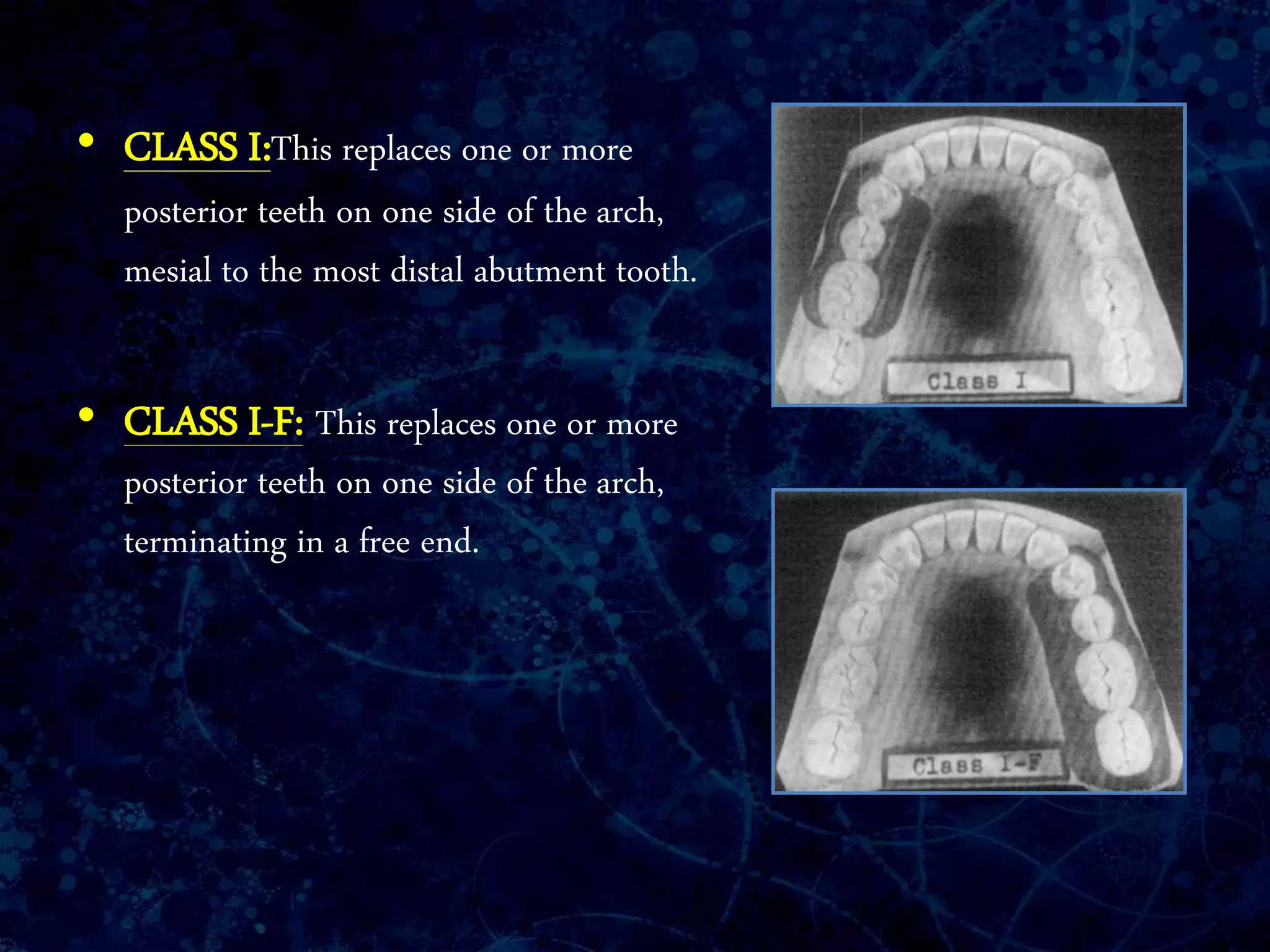 • CLASS I:This replaces one or more
posterior teeth on one side of the arch,
mesial to the most distal abutment tooth.
• CLASS I-F: This replaces one or more
posterior teeth on one side of the arch,
terminating in a free end.
 