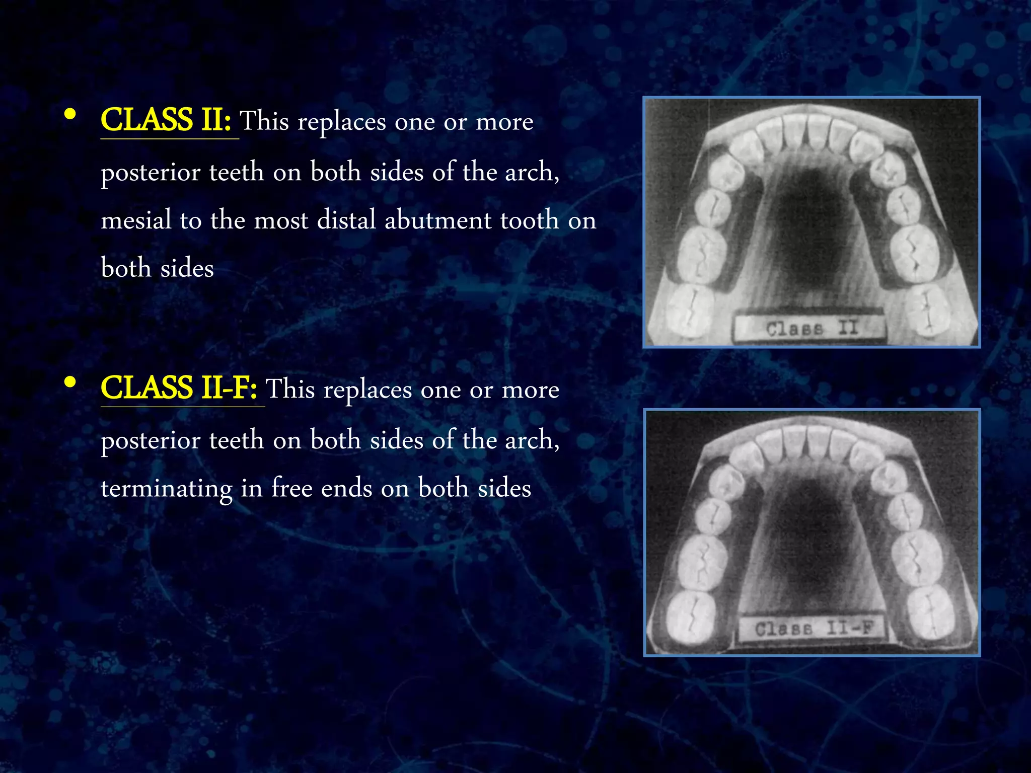 • CLASS II: This replaces one or more
posterior teeth on both sides of the arch,
mesial to the most distal abutment tooth on
both sides
• CLASS II-F: This replaces one or more
posterior teeth on both sides of the arch,
terminating in free ends on both sides
 