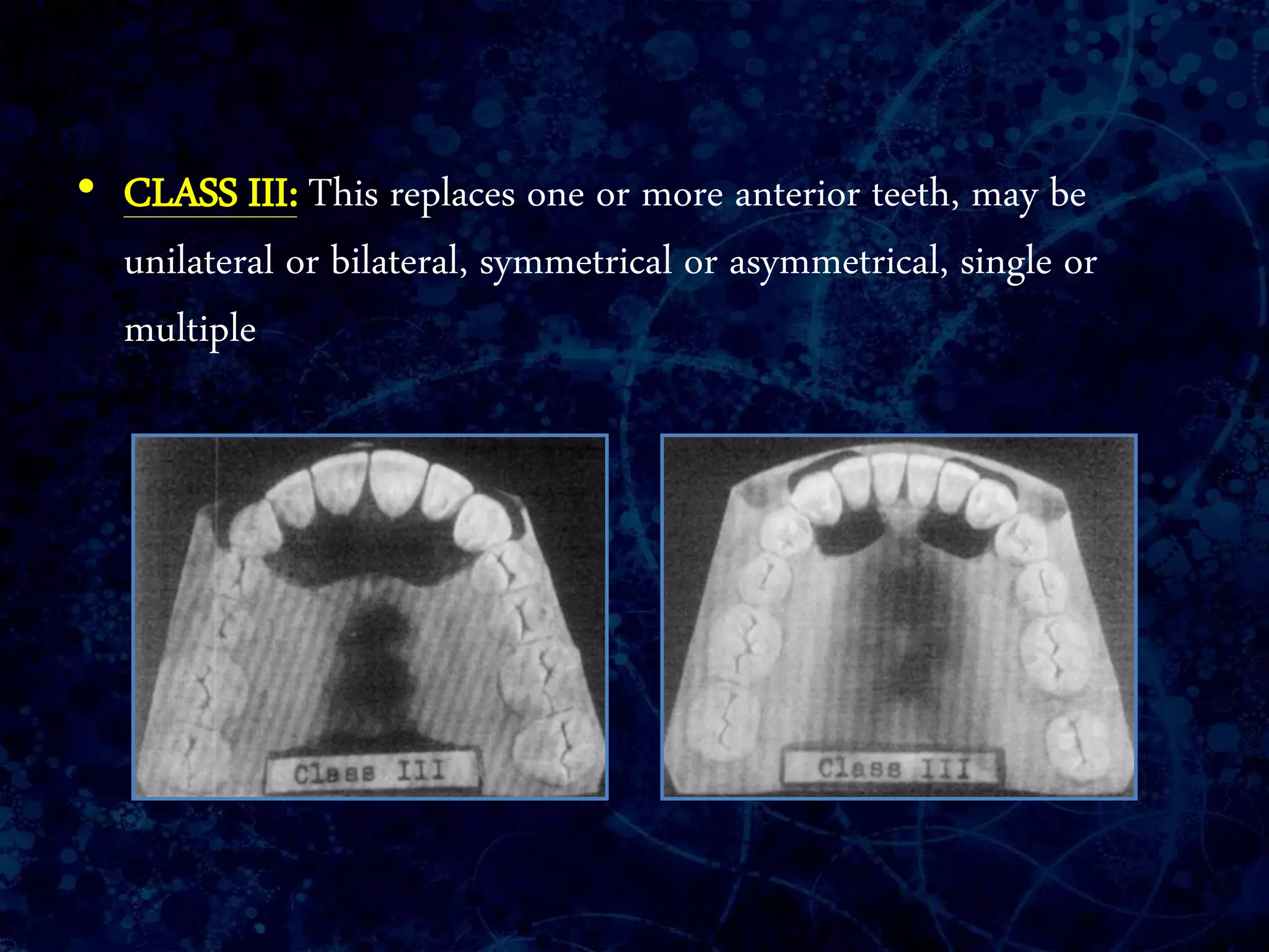 • CLASS III: This replaces one or more anterior teeth, may be
unilateral or bilateral, symmetrical or asymmetrical, single or
multiple
 