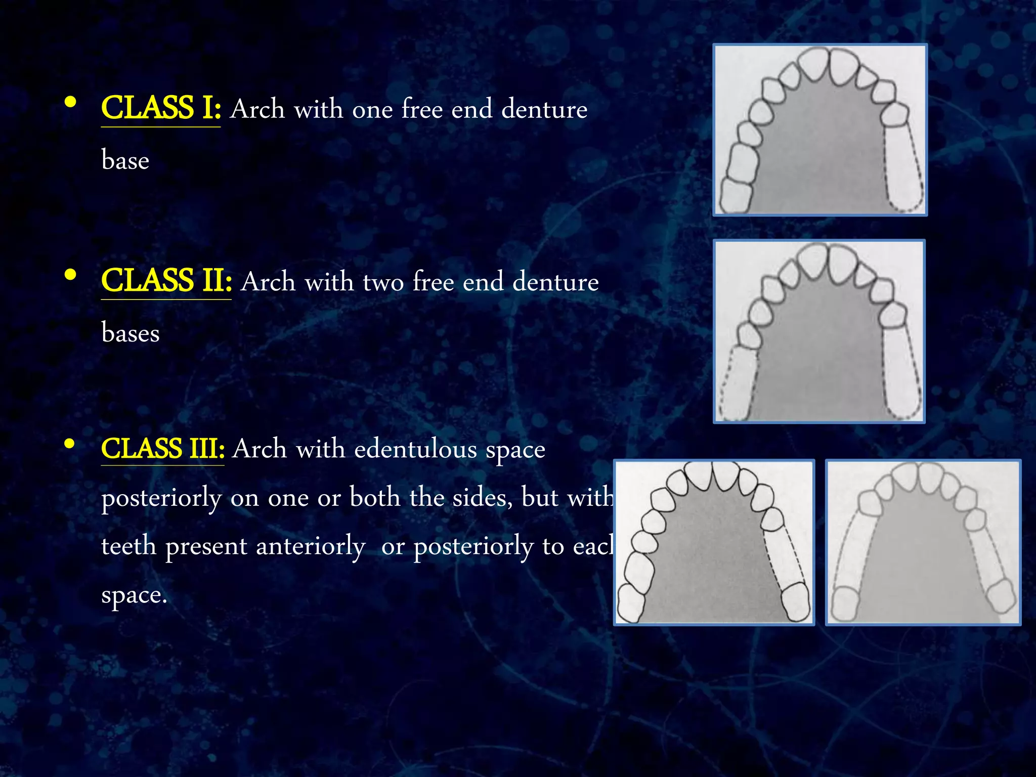 • CLASS I: Arch with one free end denture
base
• CLASS II: Arch with two free end denture
bases
• CLASS III: Arch with edentulous space
posteriorly on one or both the sides, but with
teeth present anteriorly or posteriorly to each
space.
 