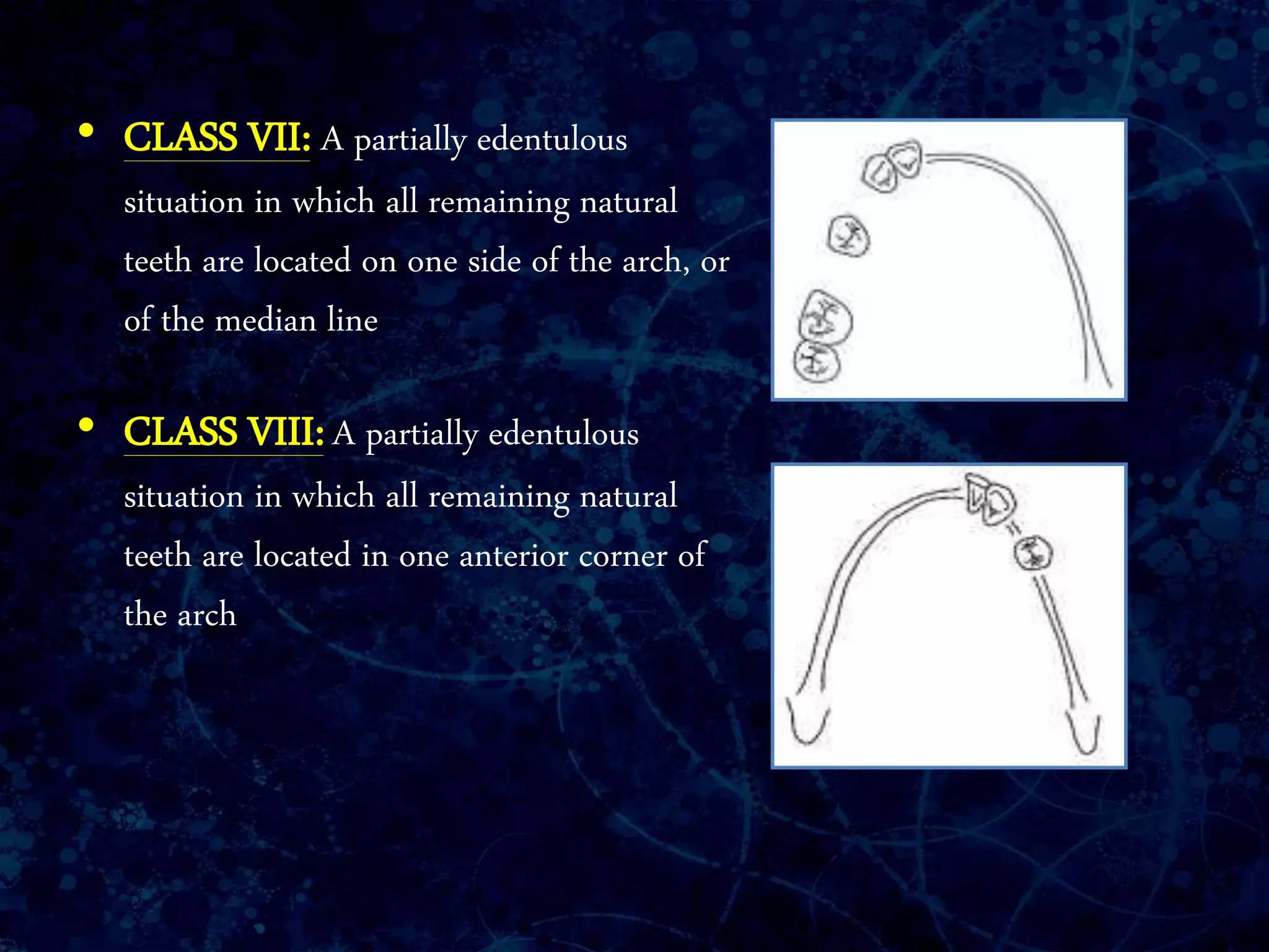 • CLASS VII: A partially edentulous
situation in which all remaining natural
teeth are located on one side of the arch, or
of the median line
• CLASS VIII: A partially edentulous
situation in which all remaining natural
teeth are located in one anterior corner of
the arch
 