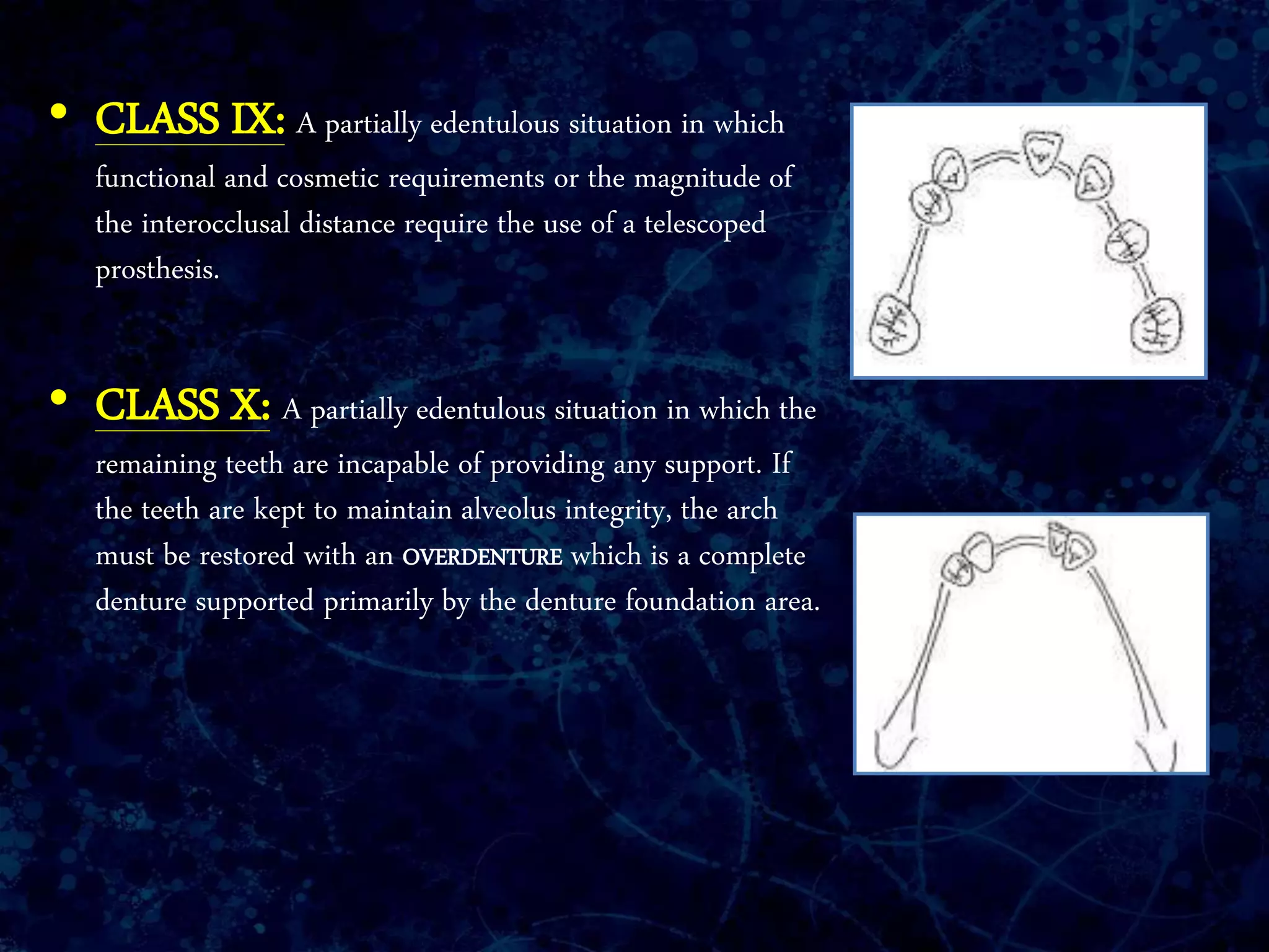 • CLASS IX: A partially edentulous situation in which
functional and cosmetic requirements or the magnitude of
the interocclusal distance require the use of a telescoped
prosthesis.
• CLASS X: A partially edentulous situation in which the
remaining teeth are incapable of providing any support. If
the teeth are kept to maintain alveolus integrity, the arch
must be restored with an OVERDENTURE which is a complete
denture supported primarily by the denture foundation area.
 