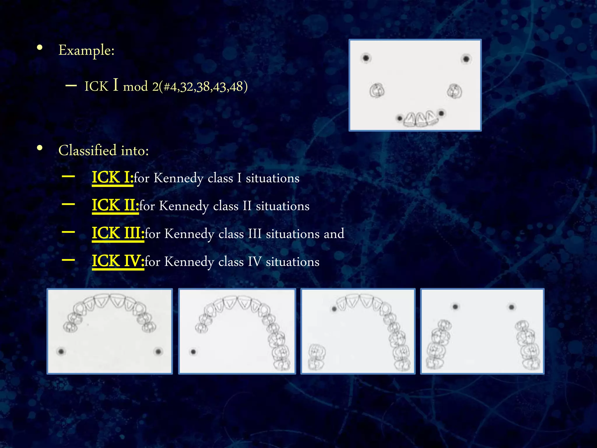 • Example:
– ICK I mod 2(#4,32,38,43,48)
• Classified into:
– ICK I:for Kennedy class I situations
– ICK II:for Kennedy class II situations
– ICK III:for Kennedy class III situations and
– ICK IV:for Kennedy class IV situations
 