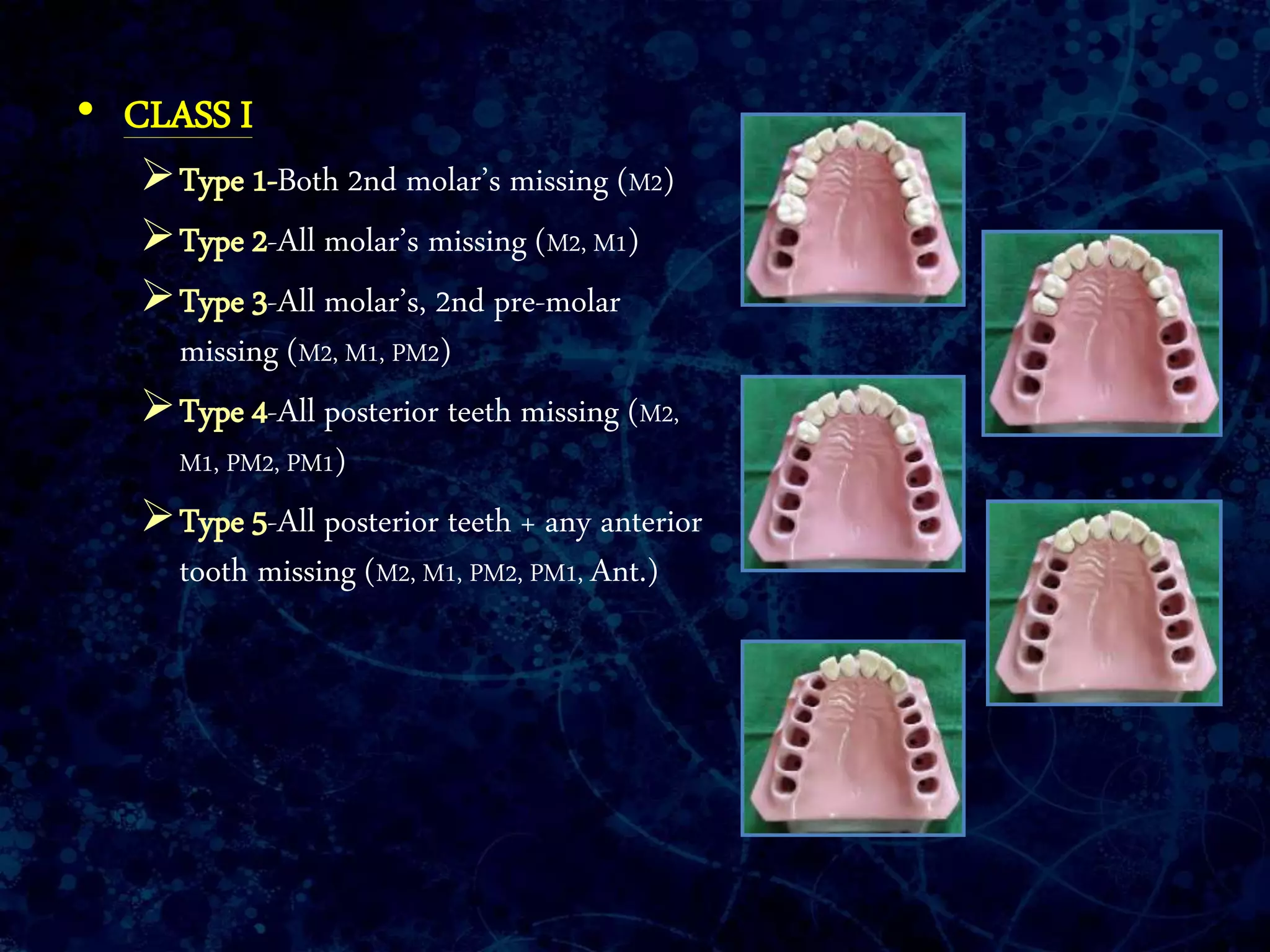 • CLASS I
Type 1-Both 2nd molar’s missing (M2)
Type 2-All molar’s missing (M2, M1)
Type 3-All molar’s, 2nd pre-molar
missing (M2, M1, PM2)
Type 4-All posterior teeth missing (M2,
M1, PM2, PM1)
Type 5-All posterior teeth + any anterior
tooth missing (M2, M1, PM2, PM1, Ant.)
 