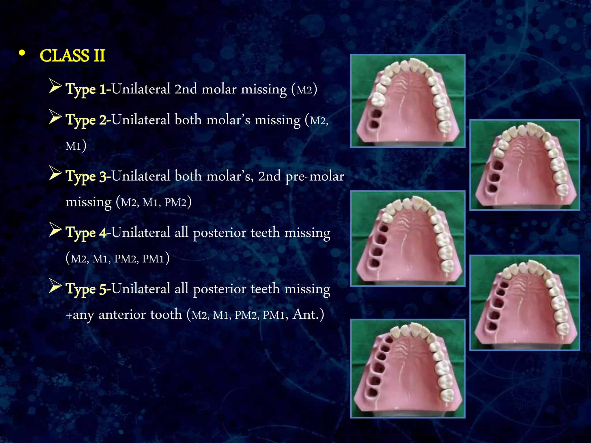 • CLASS II
Type 1-Unilateral 2nd molar missing (M2)
Type 2-Unilateral both molar’s missing (M2,
M1)
Type 3-Unilateral both molar’s, 2nd pre-molar
missing (M2, M1, PM2)
Type 4-Unilateral all posterior teeth missing
(M2, M1, PM2, PM1)
Type 5-Unilateral all posterior teeth missing
+any anterior tooth (M2, M1, PM2, PM1, Ant.)
 