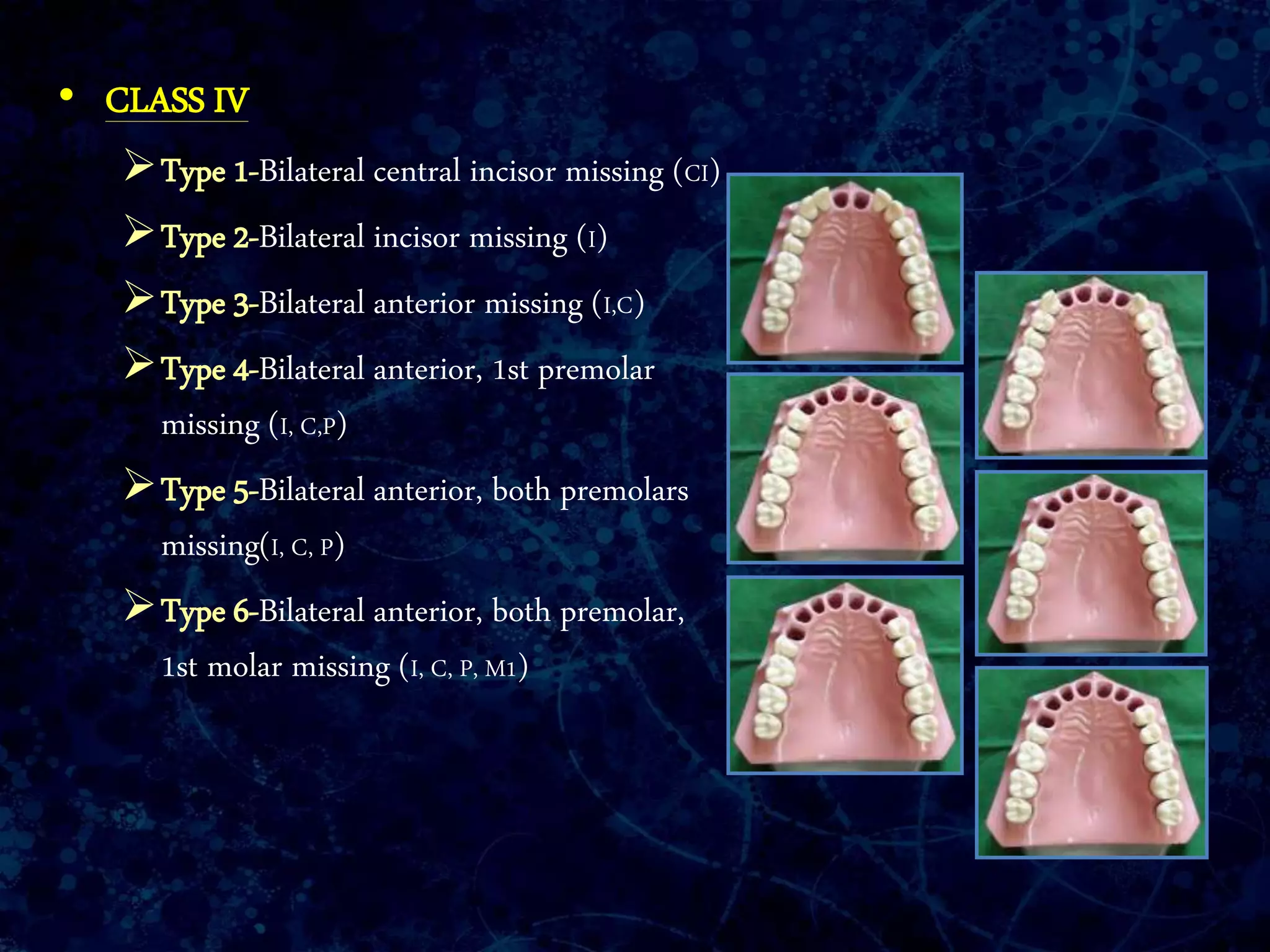 • CLASS IV
Type 1-Bilateral central incisor missing (CI)
Type 2-Bilateral incisor missing (I)
Type 3-Bilateral anterior missing (I,C)
Type 4-Bilateral anterior, 1st premolar
missing (I, C,P)
Type 5-Bilateral anterior, both premolars
missing(I, C, P)
Type 6-Bilateral anterior, both premolar,
1st molar missing (I, C, P, M1)
 