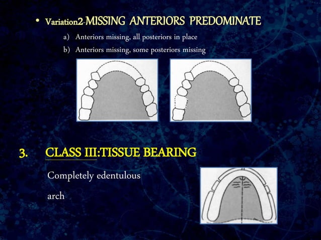 Classification of Partially Edentulous Arches | PPTX