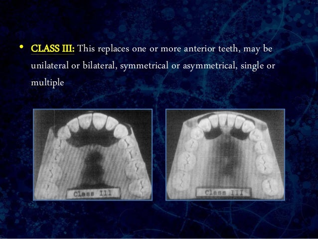 Classification of edentulous ridge - bdacatalog