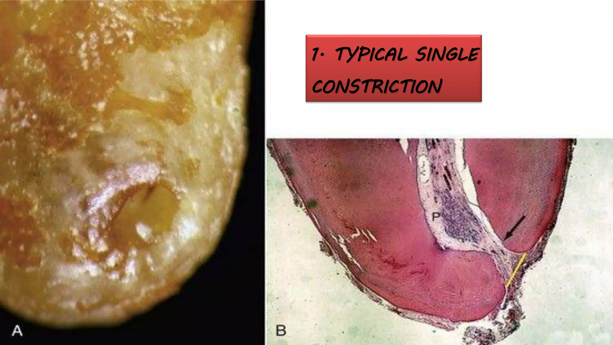1. TYPICAL SINGLE
CONSTRICTION
 
