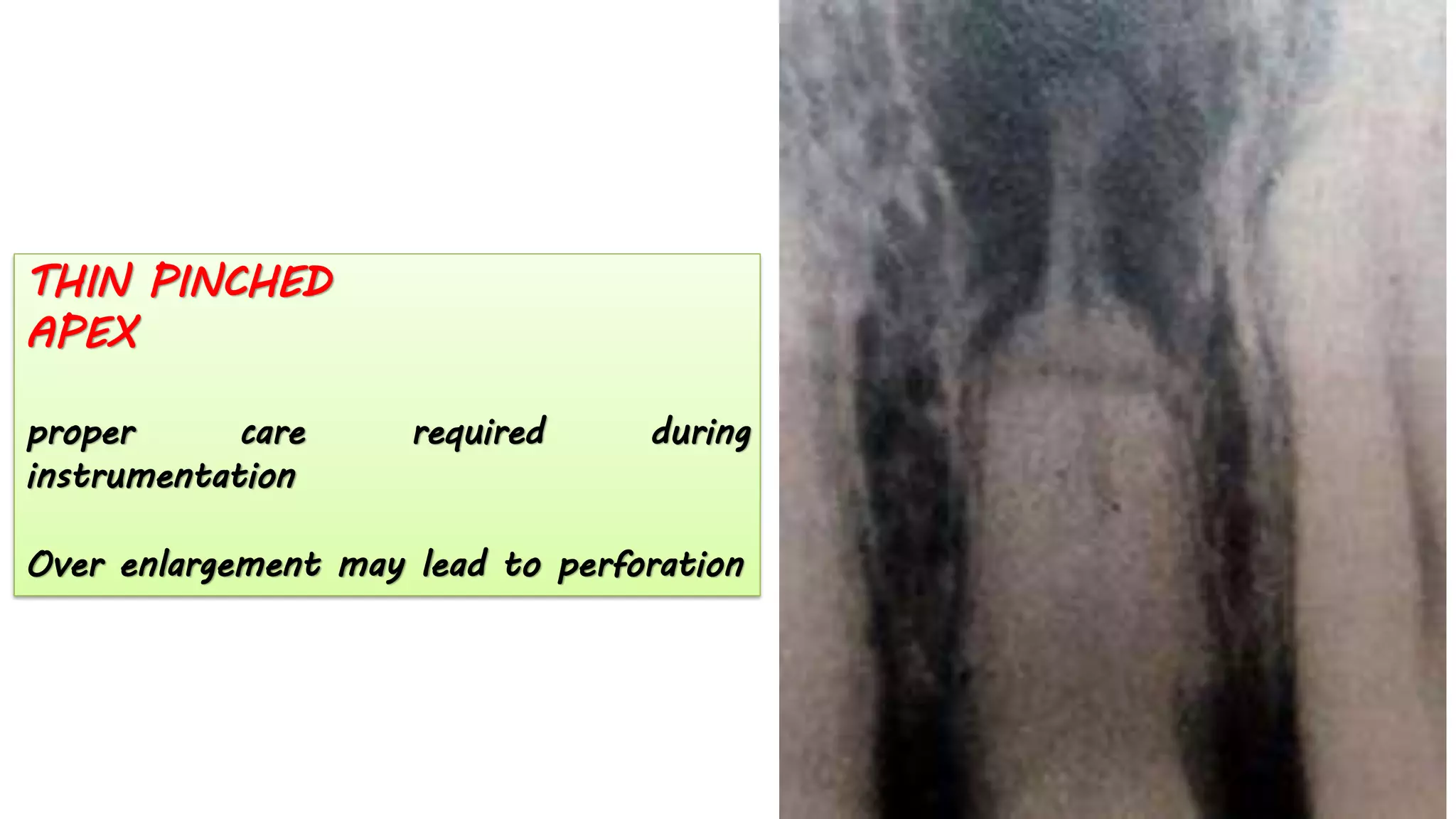 THIN PINCHED
APEX
proper care required during
instrumentation
Over enlargement may lead to perforation
 