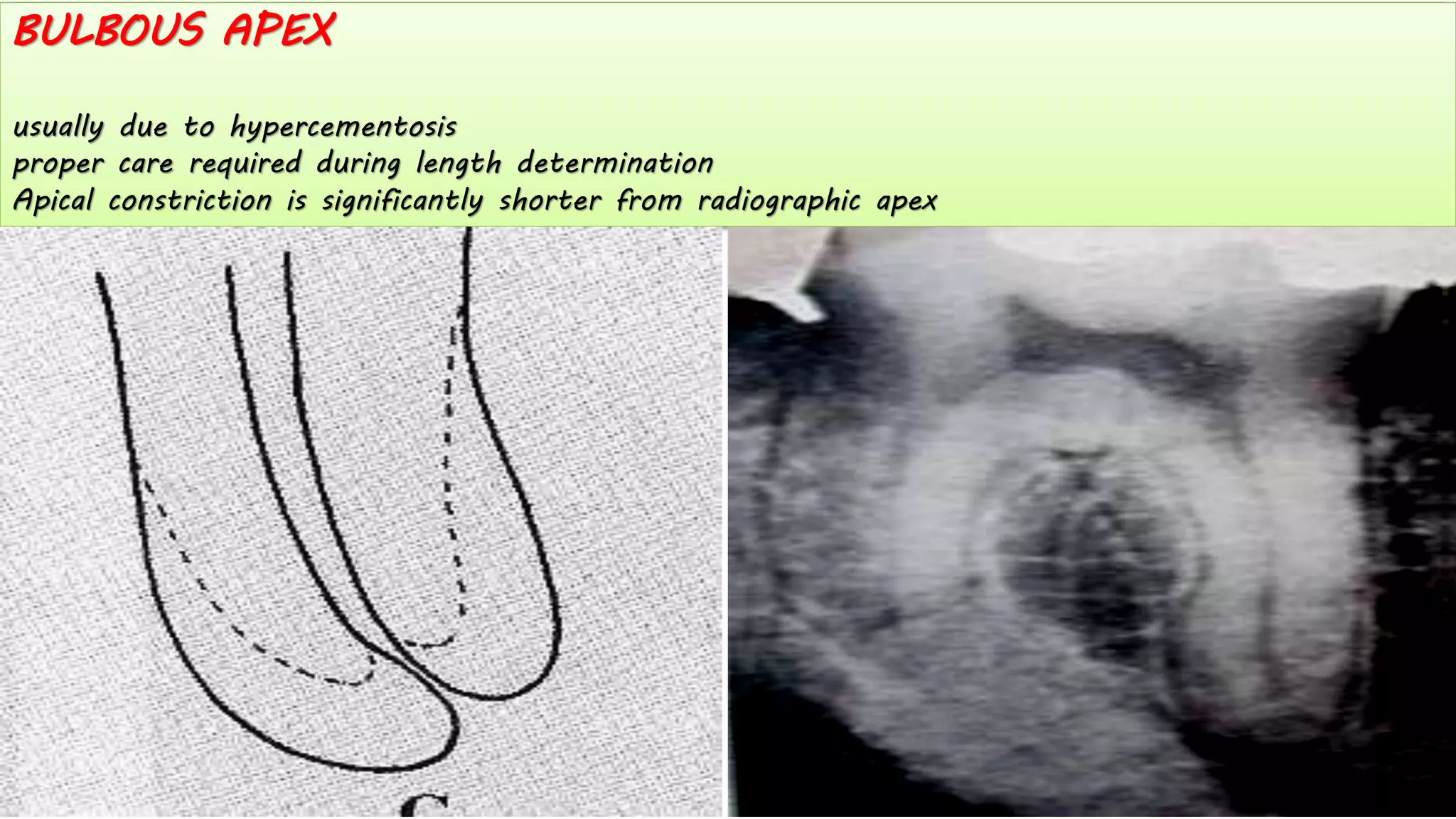 BULBOUS APEX
usually due to hypercementosis
proper care required during length determination
Apical constriction is significantly shorter from radiographic apex
 