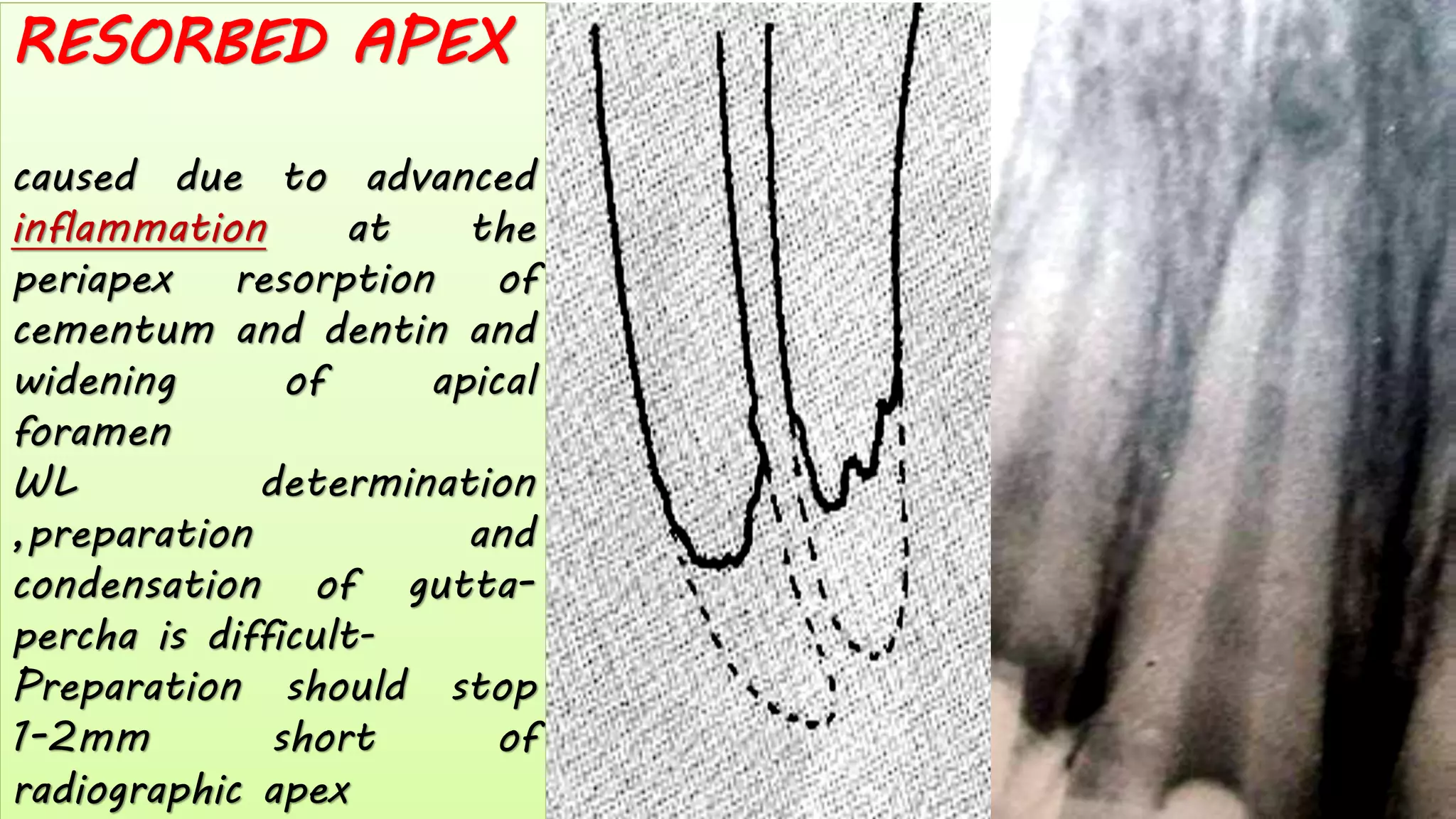 RESORBED APEX
caused due to advanced
inflammation at the
periapex resorption of
cementum and dentin and
widening of apical
foramen
WL determination
,preparation and
condensation of gutta-
percha is difficult-
Preparation should stop
1-2mm short of
radiographic apex
 