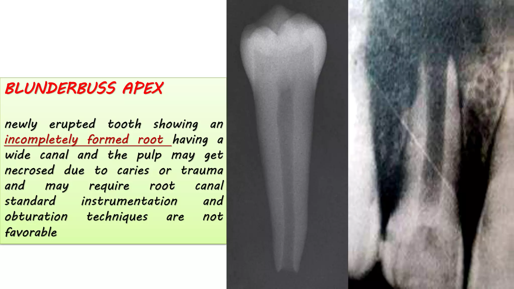 BLUNDERBUSS APEX
newly erupted tooth showing an
incompletely formed root having a
wide canal and the pulp may get
necrosed due to caries or trauma
and may require root canal
standard instrumentation and
obturation techniques are not
favorable
 