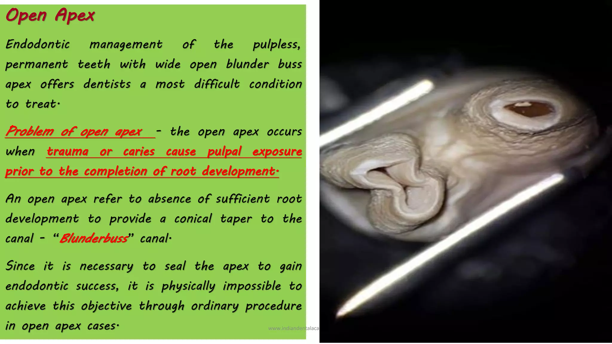 Open Apex
Endodontic management of the pulpless,
permanent teeth with wide open blunder buss
apex offers dentists a most difficult condition
to treat.
Problem of open apex - the open apex occurs
when trauma or caries cause pulpal exposure
prior to the completion of root development.
An open apex refer to absence of sufficient root
development to provide a conical taper to the
canal - “Blunderbuss” canal.
Since it is necessary to seal the apex to gain
endodontic success, it is physically impossible to
achieve this objective through ordinary procedure
in open apex cases. www.indiandentalacademy.com
 