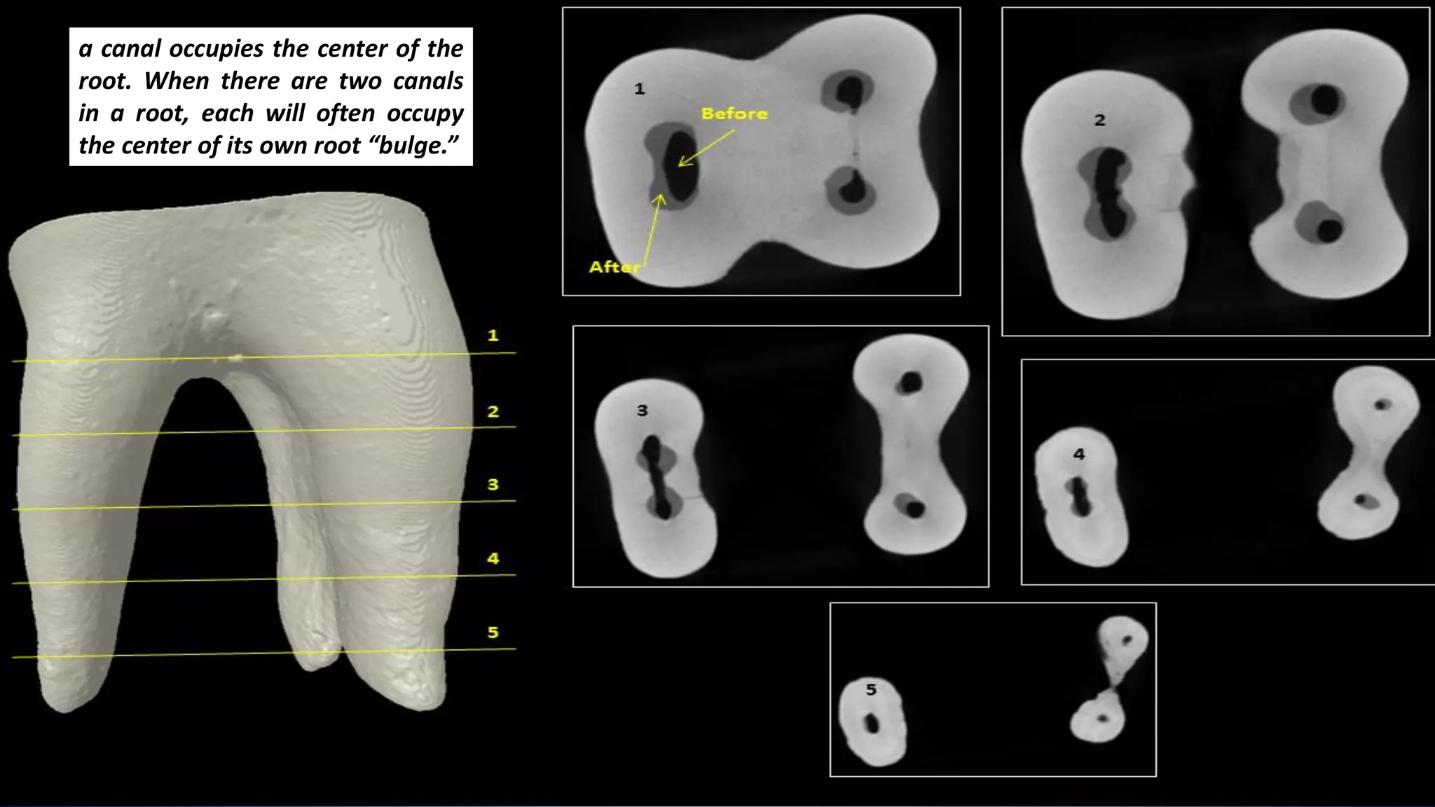 a canal occupies the center of the
root. When there are two canals
in a root, each will often occupy
the center of its own root “bulge.”
 