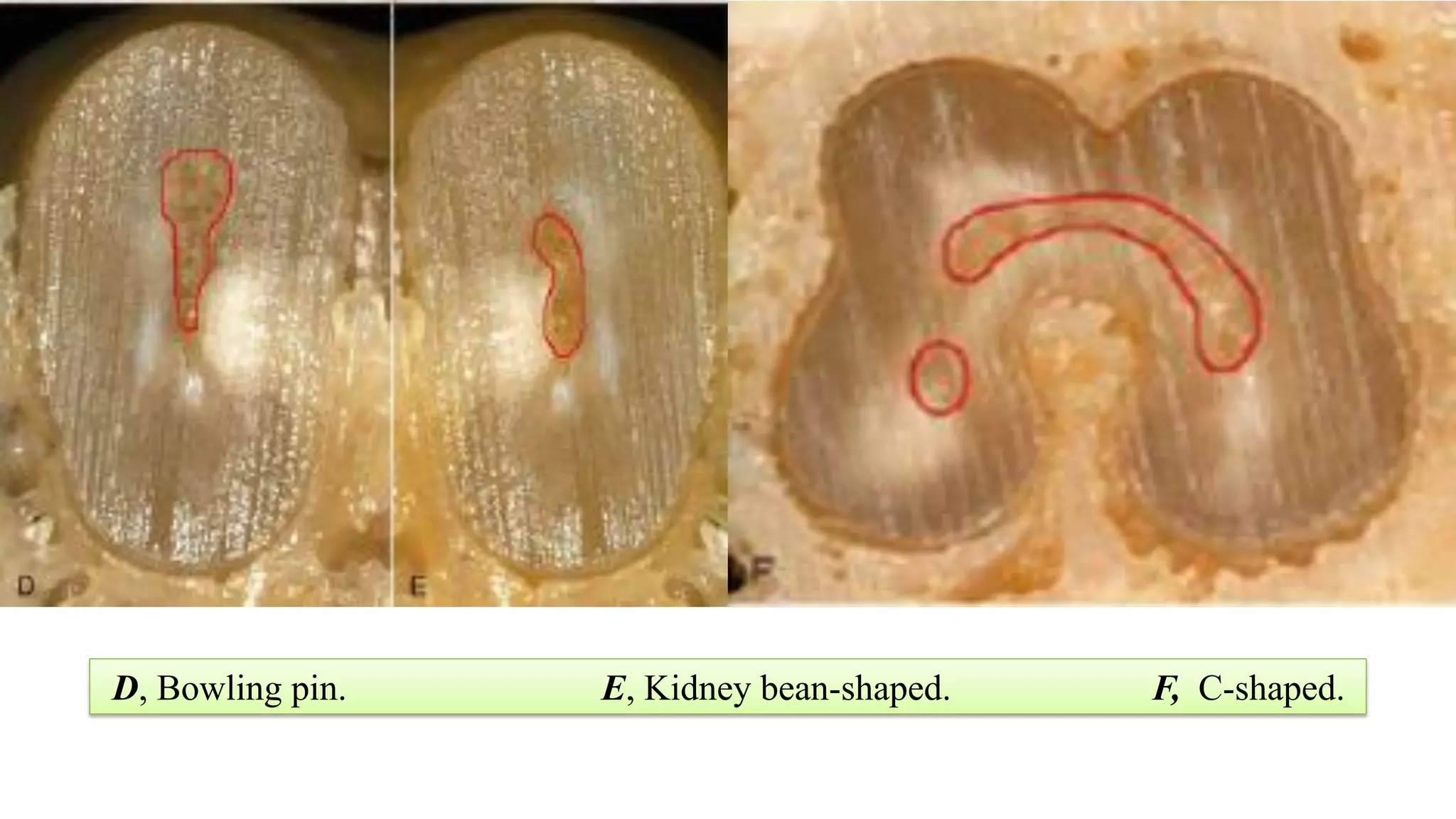 D, Bowling pin. E, Kidney bean-shaped. F, C-shaped.
 