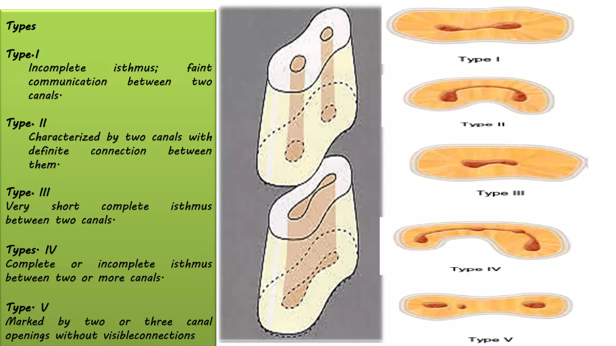 Types
Type•I
Incomplete isthmus; faint
communication between two
canals.
Type• II
Characterized by two canals with
definite connection between
them.
Type• III
Very short complete isthmus
between two canals.
Types. IV
Complete or incomplete isthmus
between two or more canals.
Type. V
Marked by two or three canal
openings without visibleconnections
 