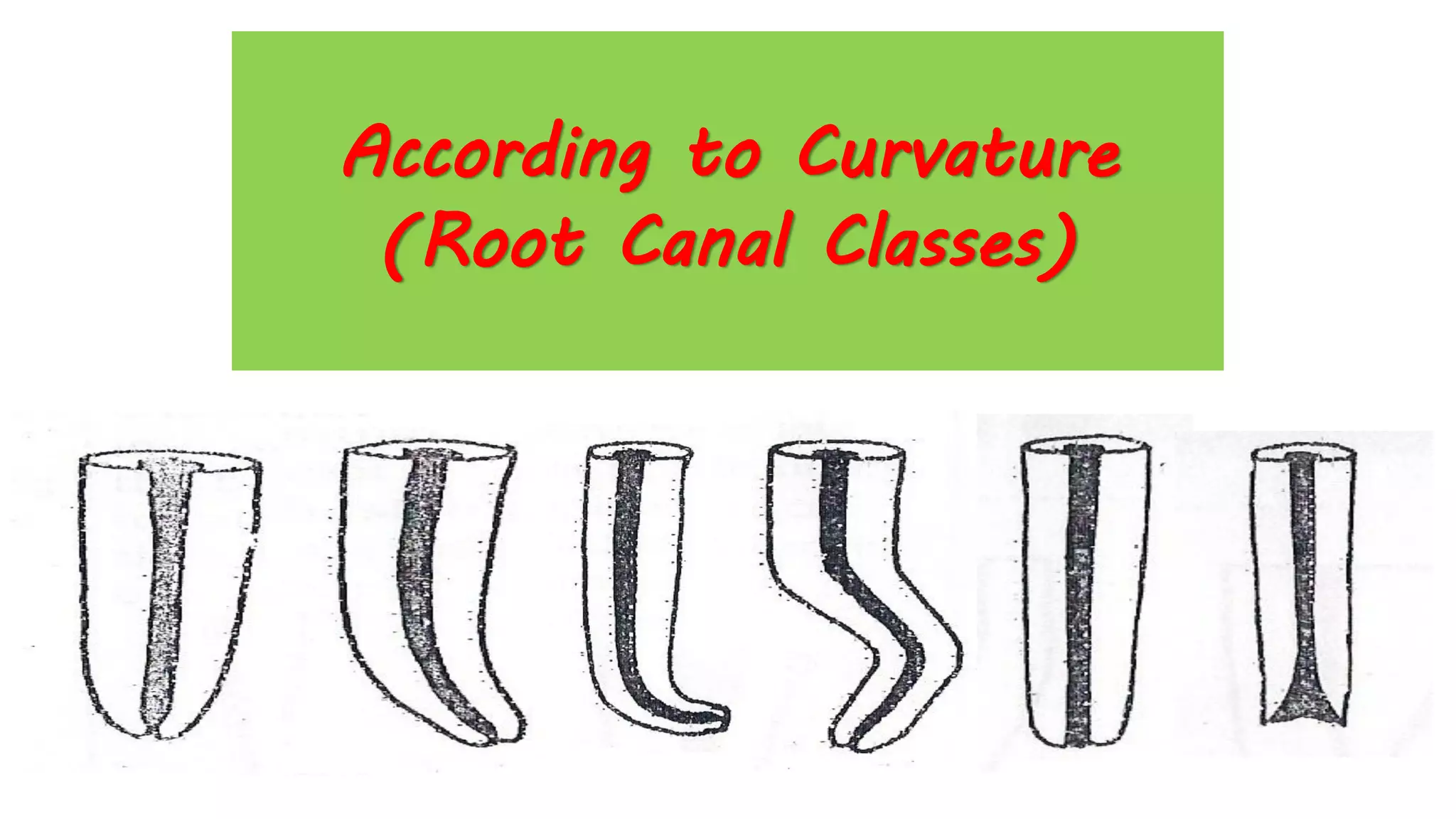 According to Curvature
(Root Canal Classes)
 