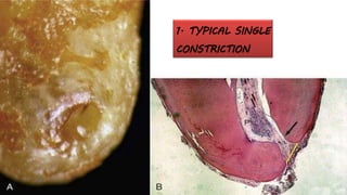 1. TYPICAL SINGLE
CONSTRICTION
 