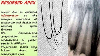 RESORBED APEX
caused due to advanced
inflammation at the
periapex resorption of
cementum and dentin and
widening of apical
foramen
WL determination
,preparation and
condensation of gutta-
percha is difficult-
Preparation should stop
1-2mm short of
radiographic apex
 