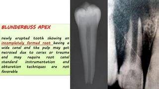 BLUNDERBUSS APEX
newly erupted tooth showing an
incompletely formed root having a
wide canal and the pulp may get
necrosed due to caries or trauma
and may require root canal
standard instrumentation and
obturation techniques are not
favorable
 