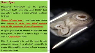 Open Apex
Endodontic management of the pulpless,
permanent teeth with wide open blunder buss
apex offers dentists a most difficult condition
to treat.
Problem of open apex - the open apex occurs
when trauma or caries cause pulpal exposure
prior to the completion of root development.
An open apex refer to absence of sufficient root
development to provide a conical taper to the
canal - “Blunderbuss” canal.
Since it is necessary to seal the apex to gain
endodontic success, it is physically impossible to
achieve this objective through ordinary procedure
in open apex cases. www.indiandentalacademy.com
 