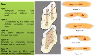 Types
Type•I
Incomplete isthmus; faint
communication between two
canals.
Type• II
Characterized by two canals with
definite connection between
them.
Type• III
Very short complete isthmus
between two canals.
Types. IV
Complete or incomplete isthmus
between two or more canals.
Type. V
Marked by two or three canal
openings without visibleconnections
 