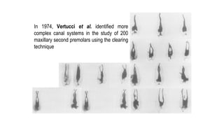 Introduction
In 1974, Vertucci et al. identified more
complex canal systems in the study of 200
maxillary second premolars using the clearing
technique
 