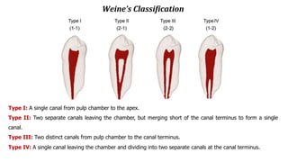 Weine’s Classification
Type I: A single canal from pulp chamber to the apex.
Type II: Two separate canals leaving the chamber, but merging short of the canal terminus to form a single
canal.
Type III: Two distinct canals from pulp chamber to the canal terminus.
Type IV: A single canal leaving the chamber and dividing into two separate canals at the canal terminus.
 