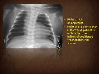 Aortic Shadow Classification of Congential Heart Diseases and cyanotic heart disease ...