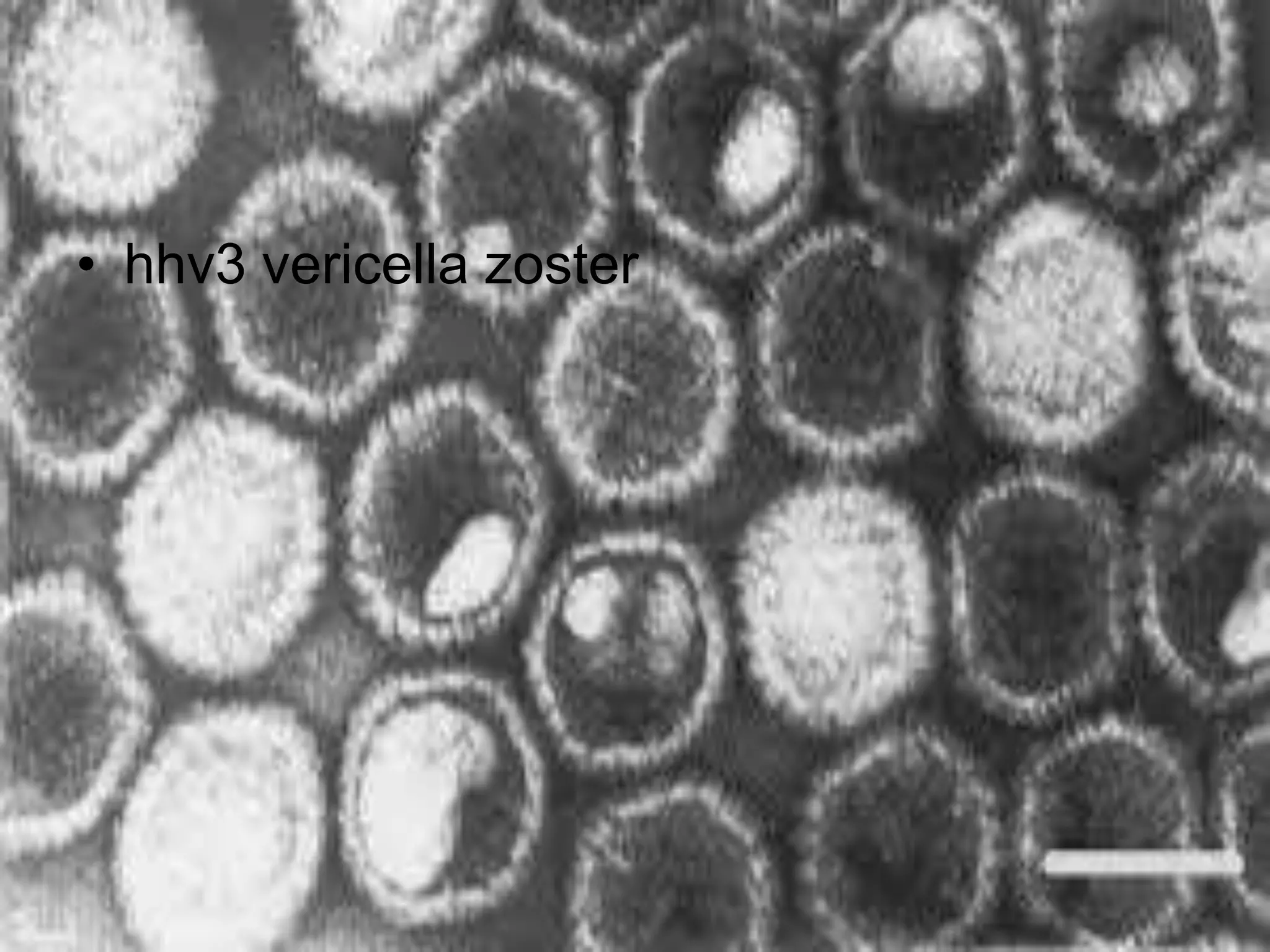 • hhv3 vericella zoster
 