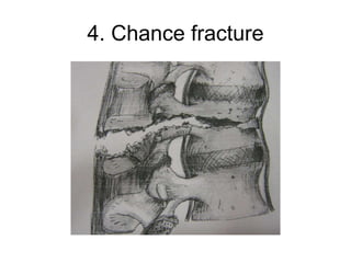 Classification and treament fracture of the spine | PPT