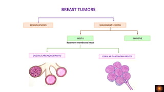 BREAST TUMORS
BENIGN LESIONS MALIGNANT LESIONS
INSITU INVASIVE
DUCTAL CARCINOMA INSITU LOBULAR CARCINOMA INSITU
Basement membrane intact
 