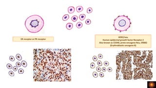 ER receptor or PR receptor
HER2/neu
Human epidermal growth factor Receptor 2
Also known as CD340, proto-oncogene Neu, ERBB2
(Erythroblastic oncogene B)
 