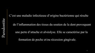 C’est une maladie infectieuse d’origine bactérienne qui résulte
de l’inflammation des tissus du soutien de la dent provoquant
une perte d’attache et alvéolyse. Elle se caractérise par la
formation de poche et/ou récession gingivale.
Parodontite
42
 