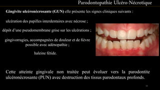 Gingivite ulcéronécrosante (GUN) elle présente les signes cliniques suivants :
Parodontopathie Ulcéro-Nécrotique
Cette atteinte gingivale non traitée peut évoluer vers la parodontite
ulcéronécrosante (PUN) avec destruction des tissus parodontaux profonds.
ulcération des papilles interdentaires avec nécrose ;
dépôt d’une pseudomembrane grise sur les ulcérations ;
gingivorragies, accompagnées de douleur et de ﬁèvre
possible avec adénopathie ;
haleine fétide.
50
 