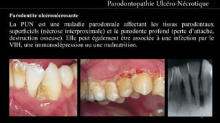 Parodontite ulcéronécrosante
La PUN est une maladie parodontale affectant les tissus parodontaux
superﬁciels (nécrose interproximale) et le parodonte profond (perte d’attache,
destruction osseuse). Elle peut également être associée à une infection par le
VIH, une immunodépression ou une malnutrition.
Parodontopathie Ulcéro-Nécrotique
51
 