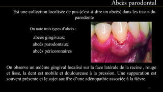 abcès gingivaux;
abcès parodontaux;
abcès péricoronaires
Abcès parodontal
Est une collection localisée de pus (c'est-à-dire un abcès) dans les tissus du
parodonte
On observe un œdème gingival localisé sur la face latérale de la racine , rouge
et lisse, la dent est mobile et douloureuse à la pression. Une suppuration est
souvent présente et le sujet souffre d’une adénopathie associée à la ﬁèvre.
On note trois types d’abcès :
52
 